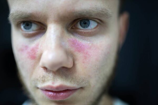 Wpływ alkoholu na skórę: Dlaczego twarz robi się czerwona?